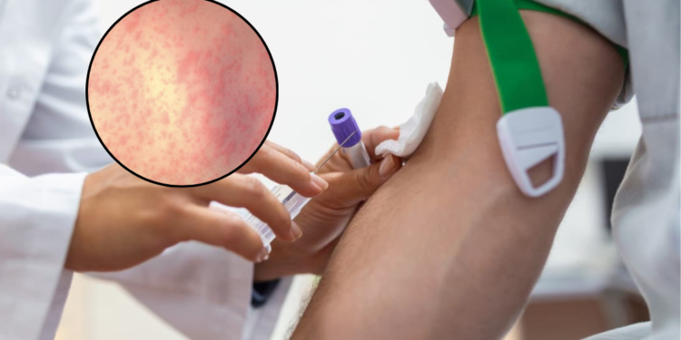 Colombia refuerza controles ante aumento de contagios de sarampión debido a 4 casos sospechosos